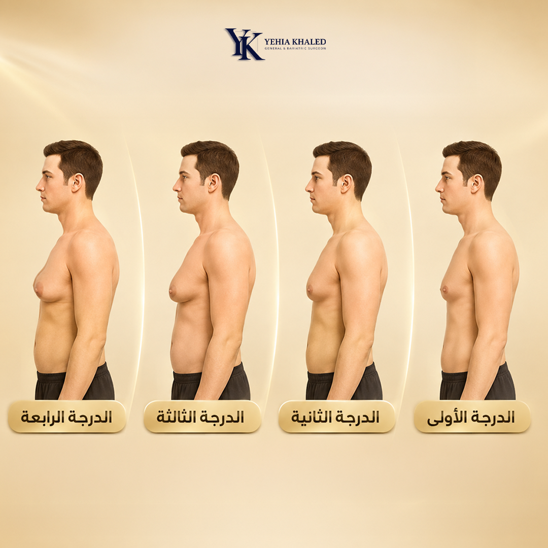 علاج التثدي عند الرجال - جراحات تنسيق القوام - الدكتور يحيى خالد