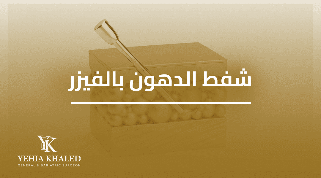 عملية شفط الدهون بالفيزر