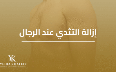 ازالة التثدي عند الرجال