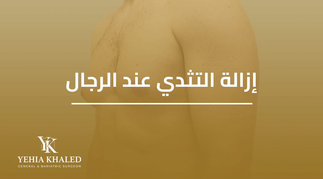 ازالة التثدي عند الرجال