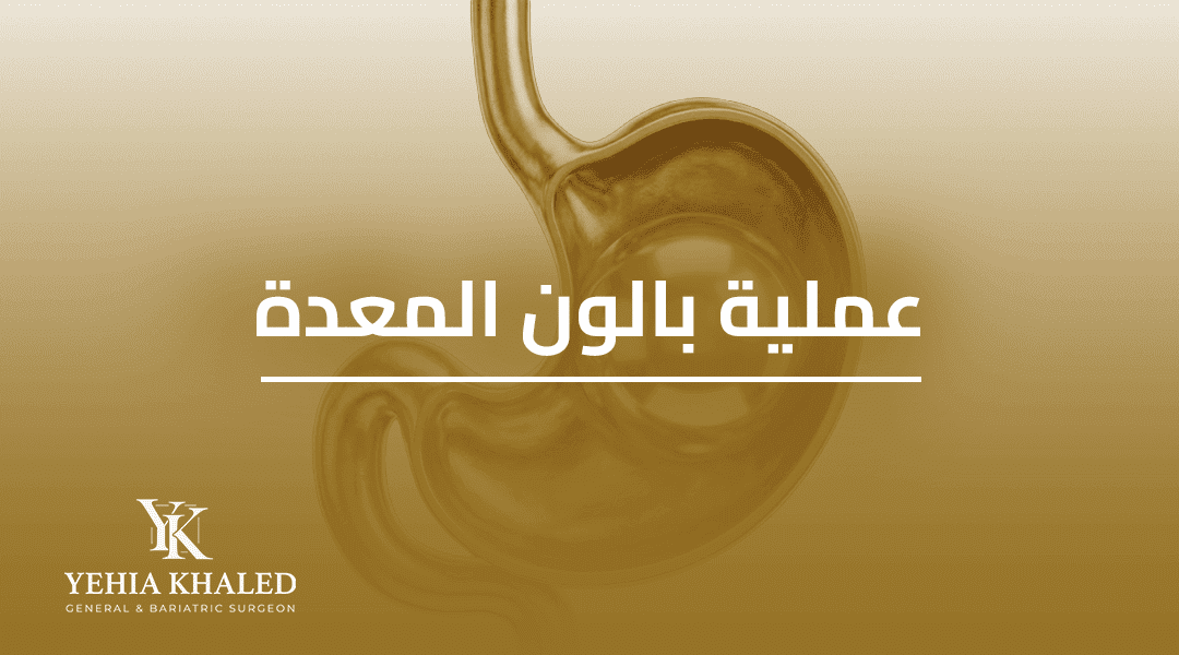 عملية بالون المعدة
