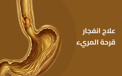 علاج إنفجار قرحة المريء