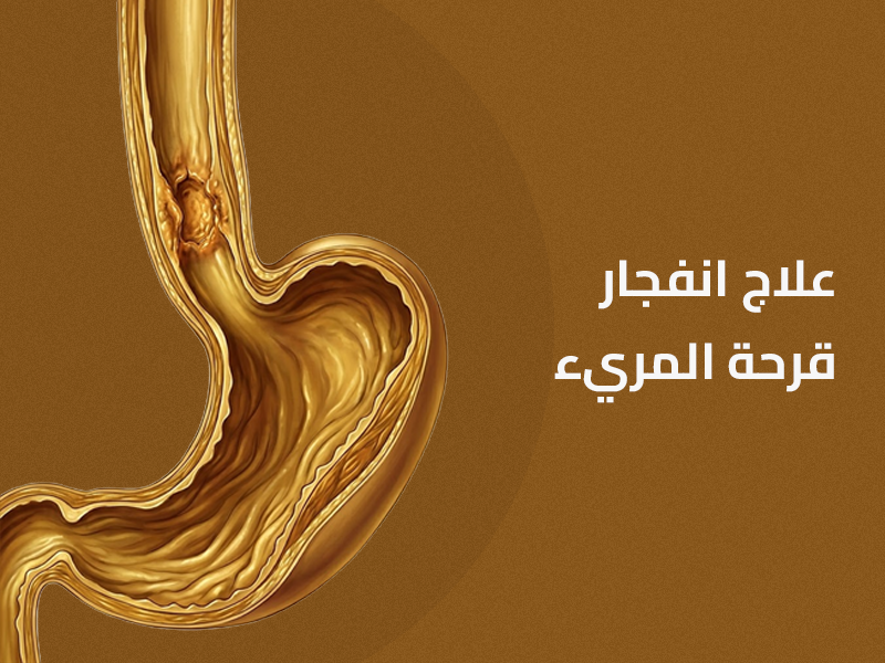 علاج إنفجار قرحة المريء