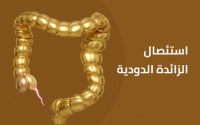 استئصال الزائدة الدودية