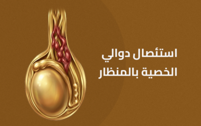 استئصال دوالي الخصية بالمنظار