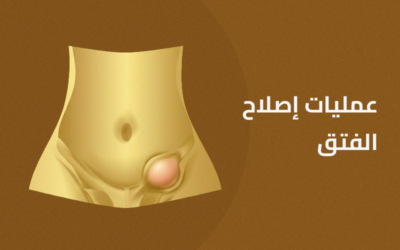 عمليات إصلاح الفتق