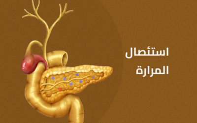 استئصال المرارة