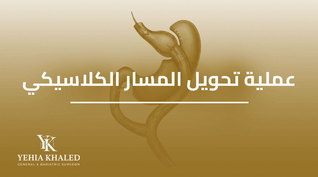 عملية تحويل المسار الكلاسيكي | دليلك الشامل