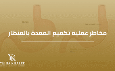 مخاطر عملية تكميم المعدة بالمنظار وكيفية تجنبها