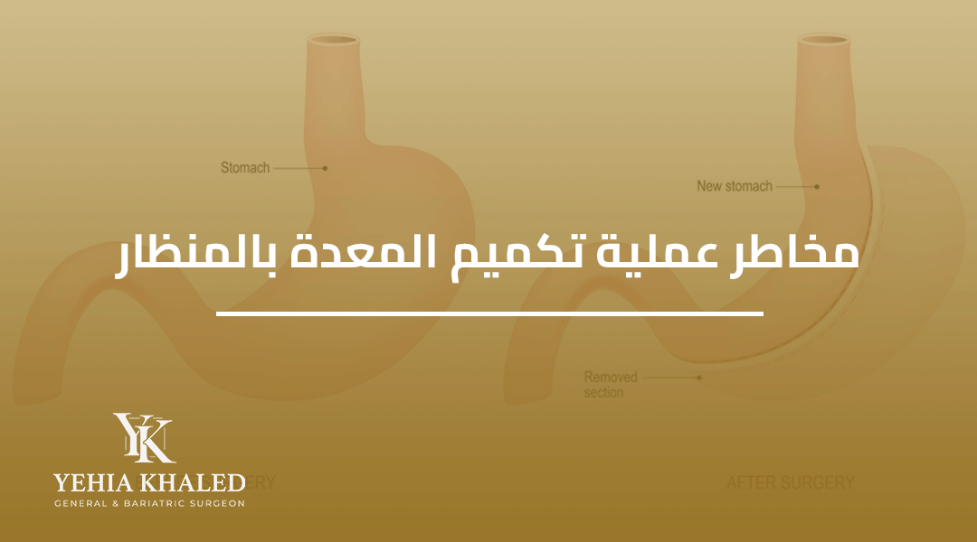 مخاطر عملية تكميم المعدة بالمنظار مخاطر عملية تكميم المعدة بالمنظار